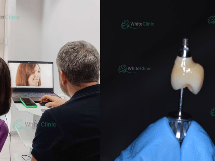 Скільки коштує імплантація зубів в Україні та світі: порівняння цін