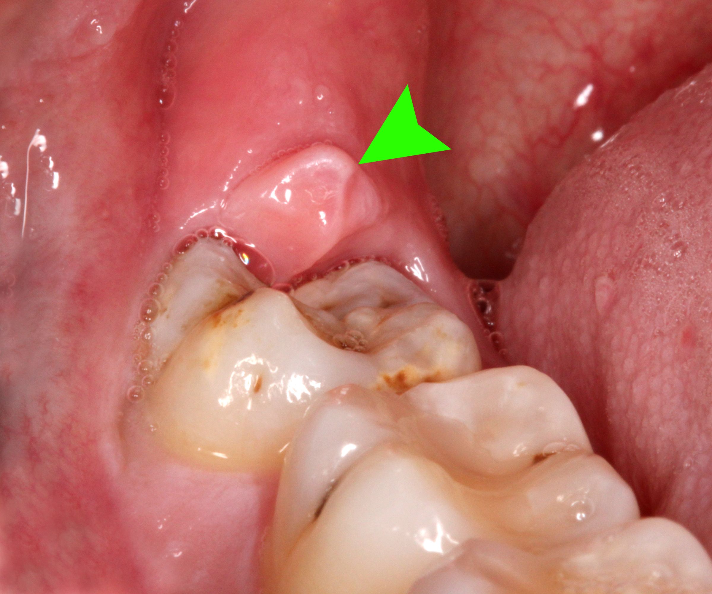 48 Clinical Pericornitis