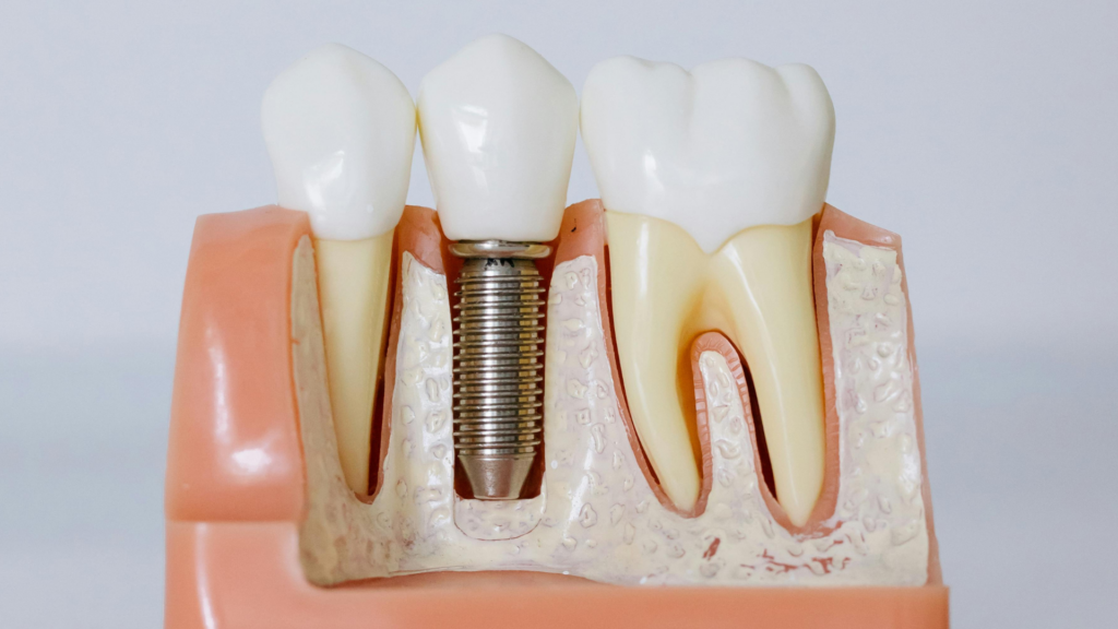 Implant 2 1024x576