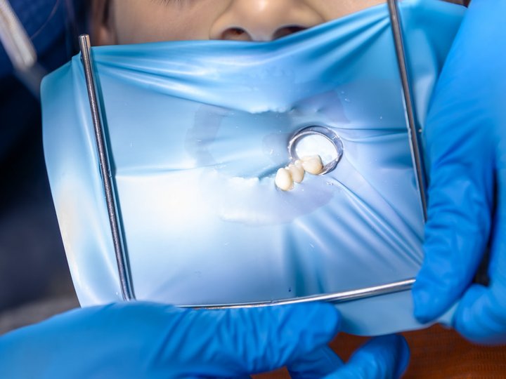 Що таке коффердам і навіщо його використовують