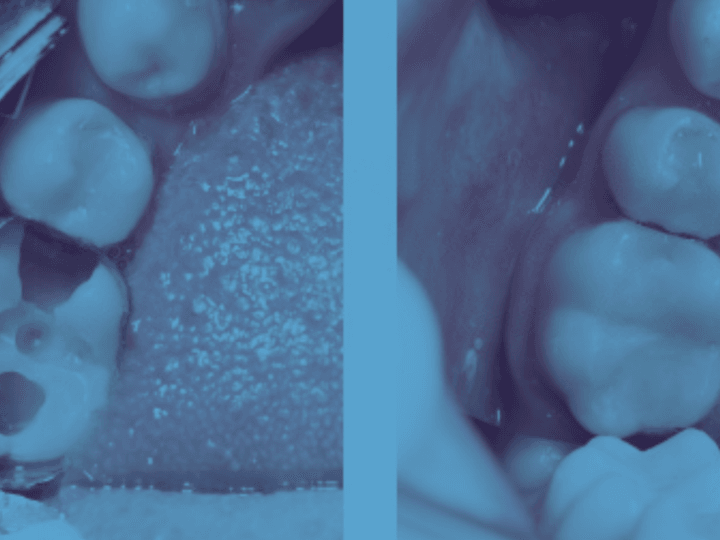 Скільки часу служить зубна пломба: на що звертати увагу