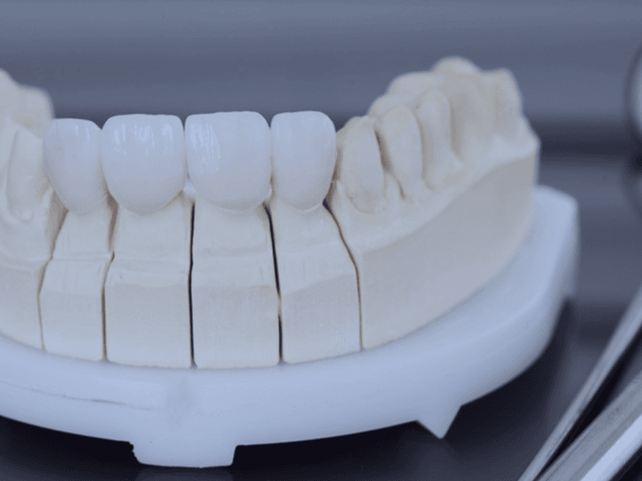 Як виготовляють цирконієві коронки: від 3D-моделі до вашої посмішки