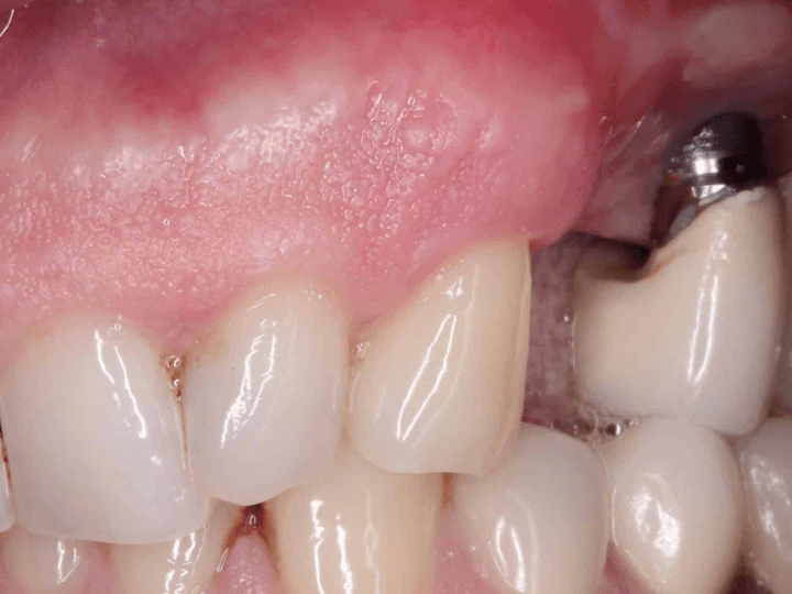 Усе про відторгнення зубного імпланту (імплантату)