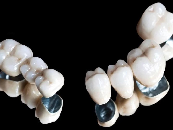 Металокерамічні коронки – переваги, показання