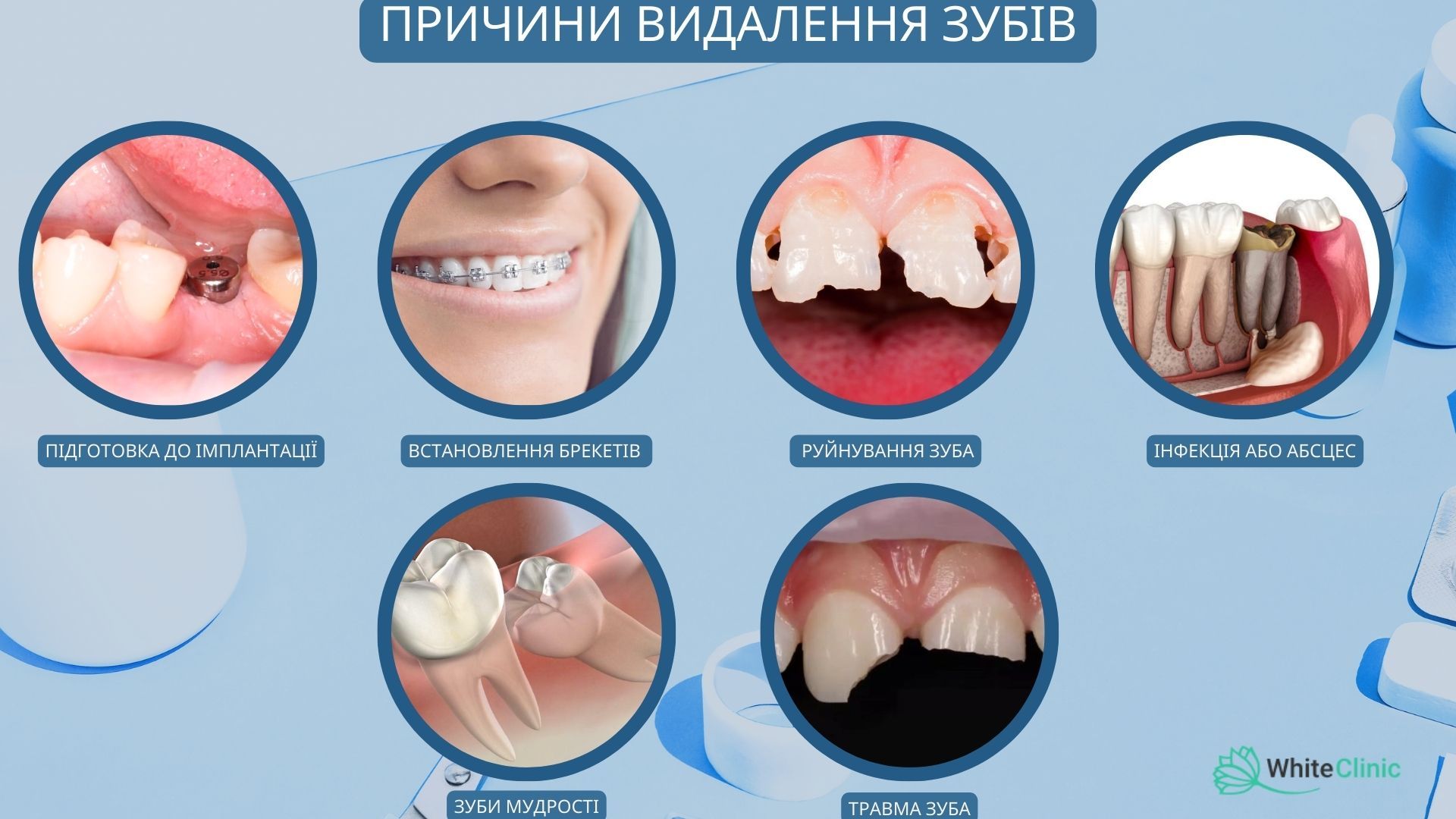Reasons for Tooth Extraction
