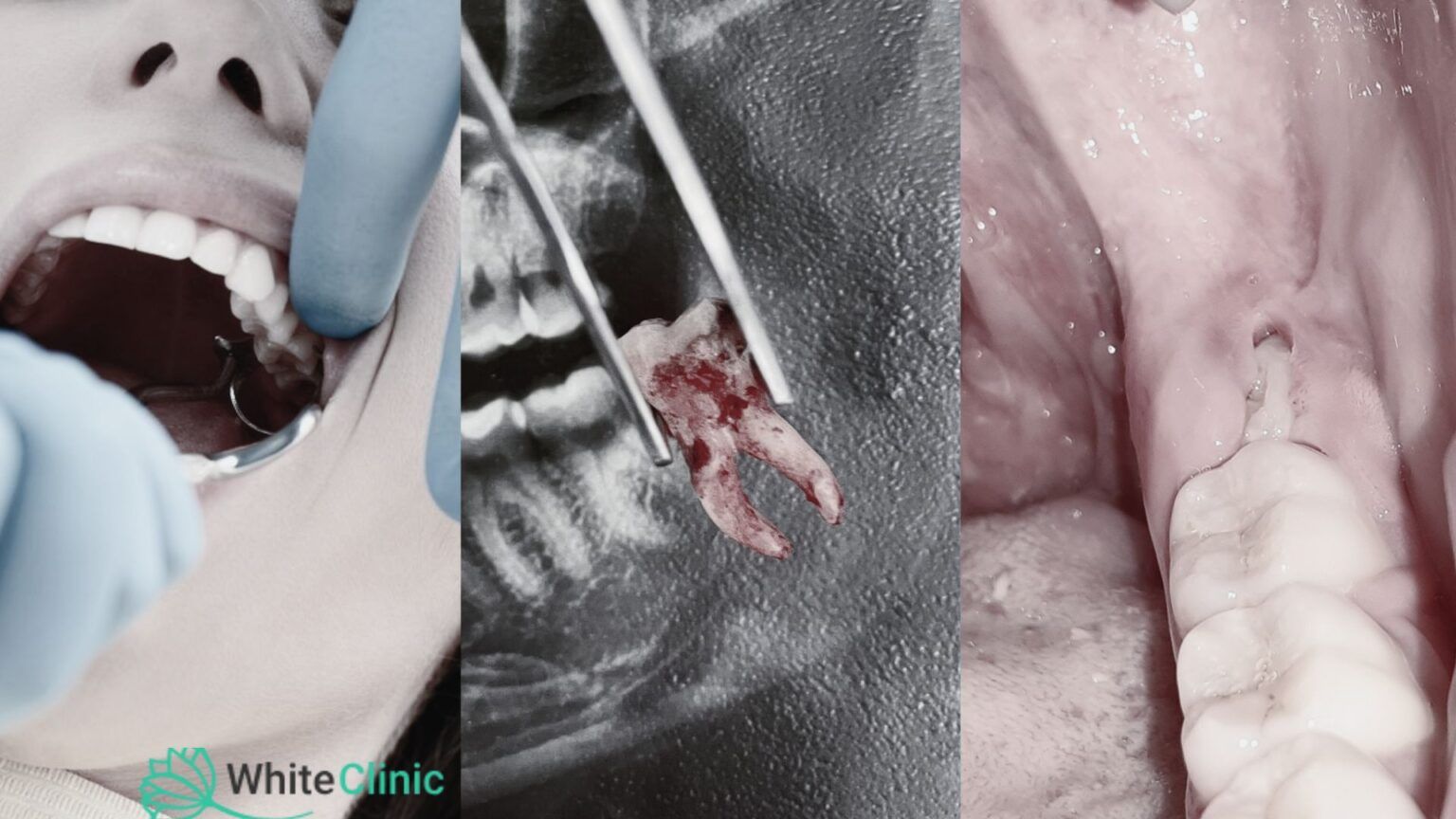 Types of Tooth Extraction 1536x864