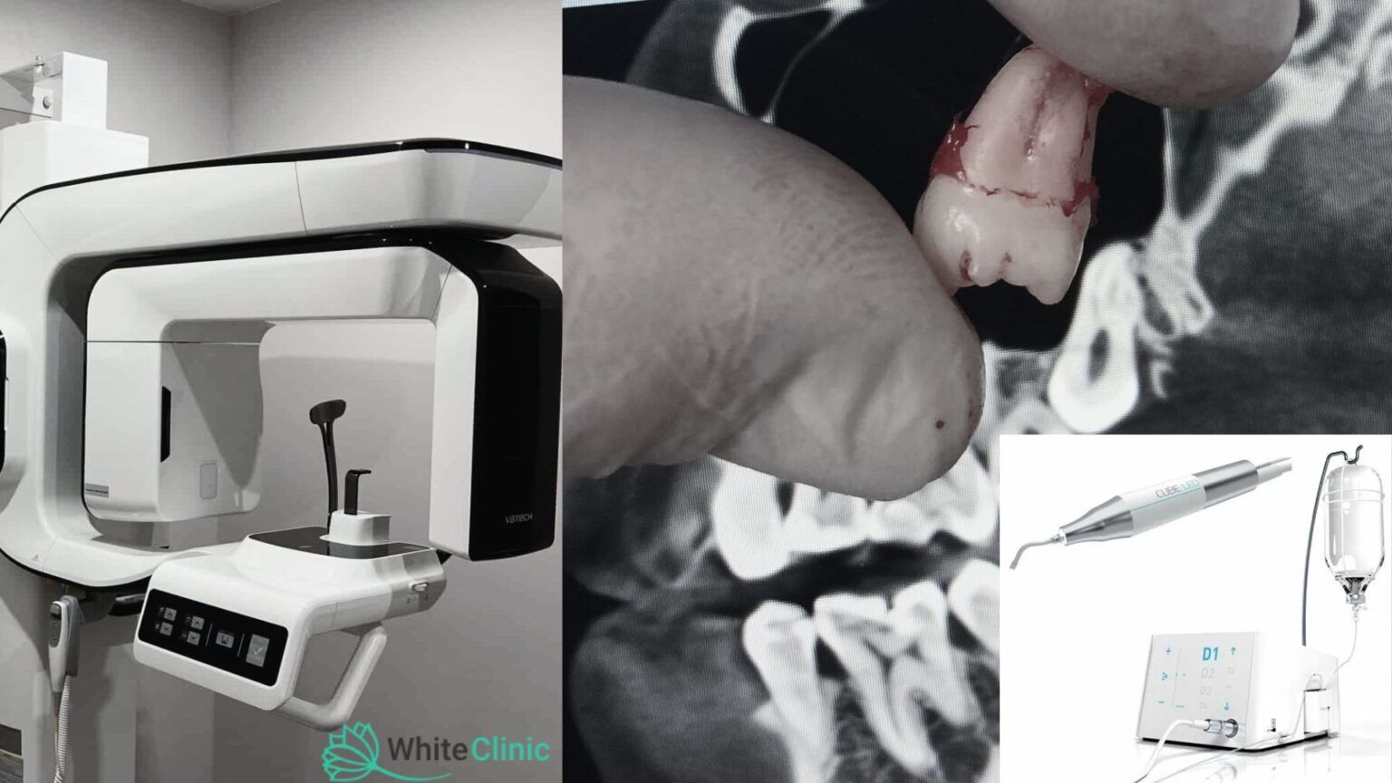 Jak Vydaljajut Zub Mudrosti 1536x864