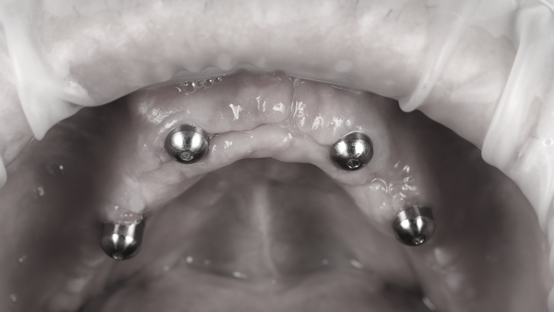 Implant (5)