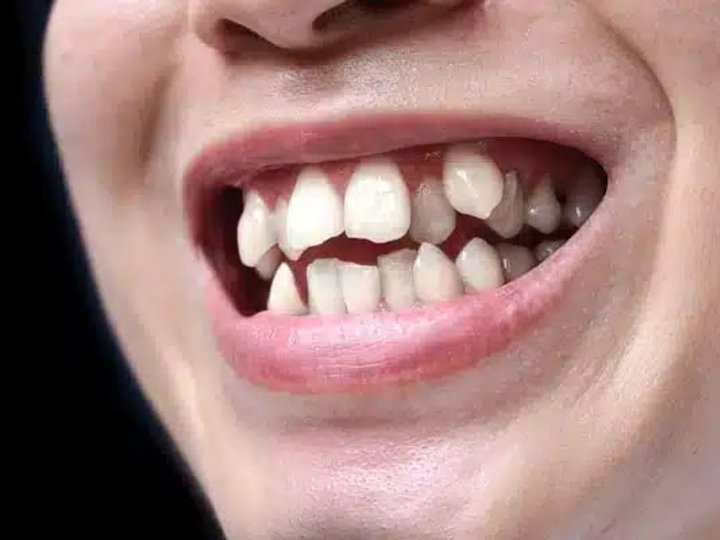 Корекція перехресного прикусу: як брекети можуть виправити прикус