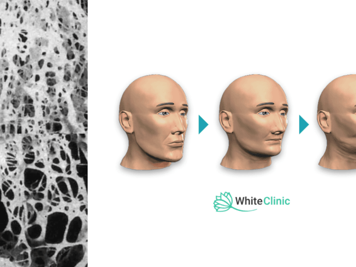 Що таке атрофія кісткової тканини