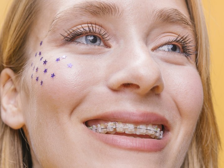 Керамічні брекети – чому вони стають популярними