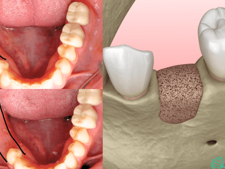 Як відбувається нарощення кісткової тканини