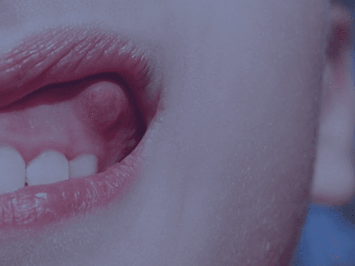 Флюс у дитини: що це і як діяти?