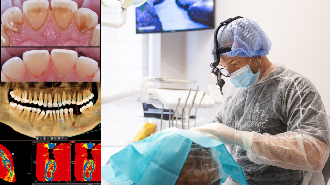 Головний лікар White Clinic &ndash; Бєгун Андрій Михайлович проводить операцію кісткової пластики після основного плану підготовки