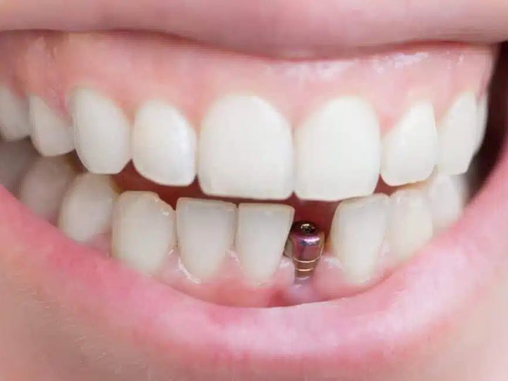 Протезування при втраті всіх зубів за допомогою дентальних імплантатів