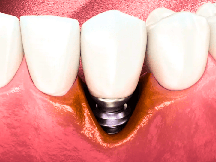 Що робити, якщо імплант не прижився: причини, рішення та профілактика
