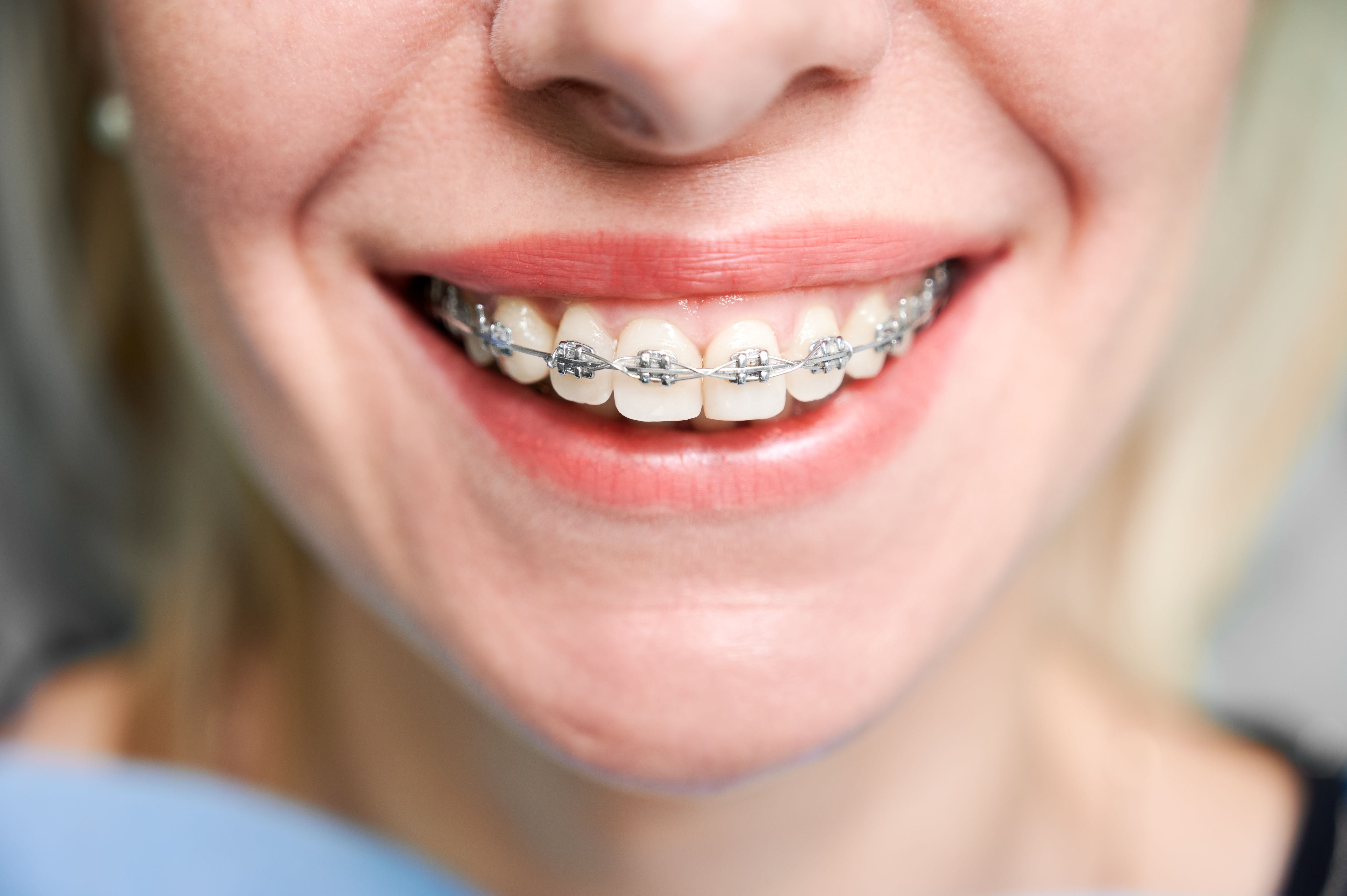 Smiling Young Woman With Braces Teeth