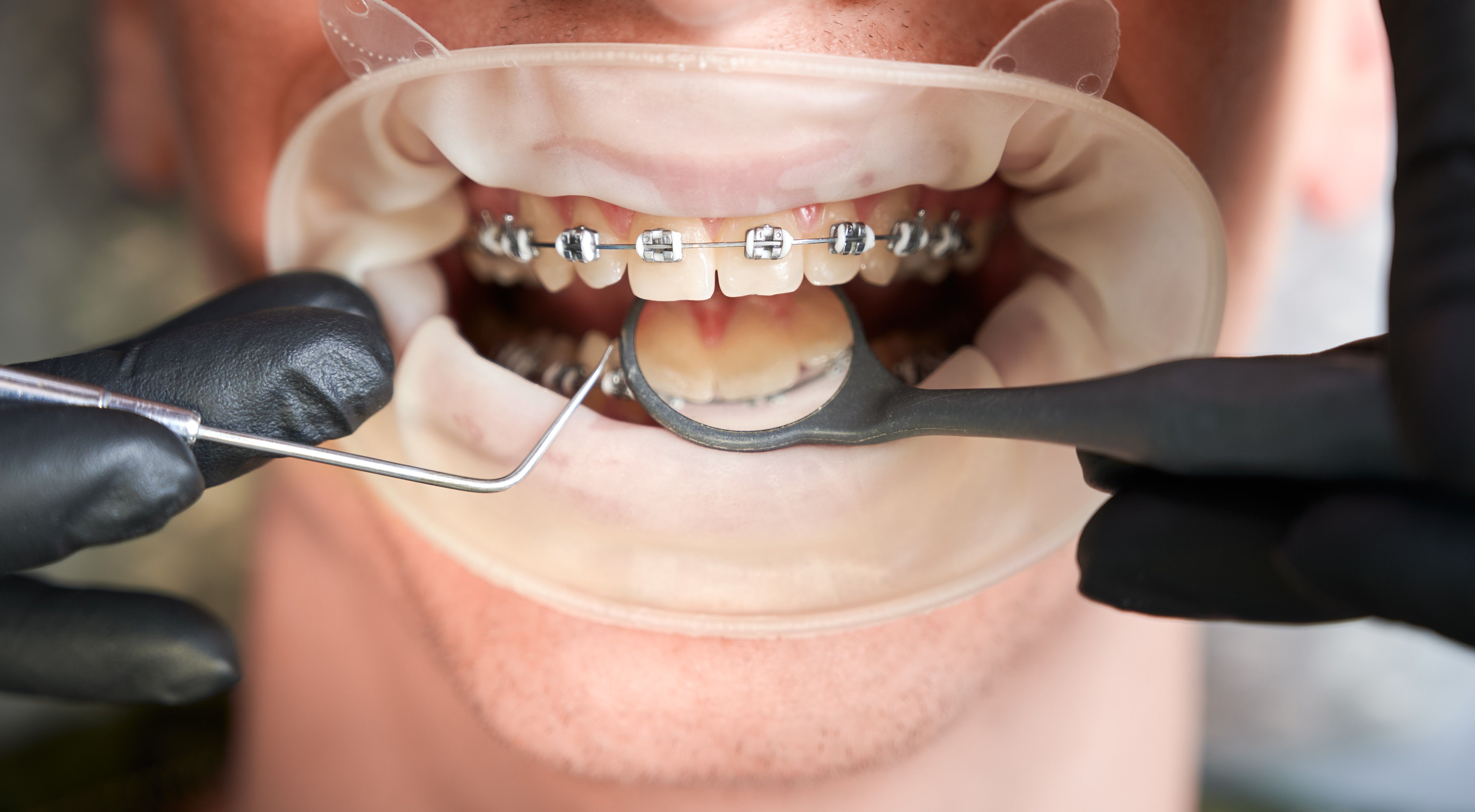 Macro Photography Human S Mouth With Metal Braces Cheek Retractor