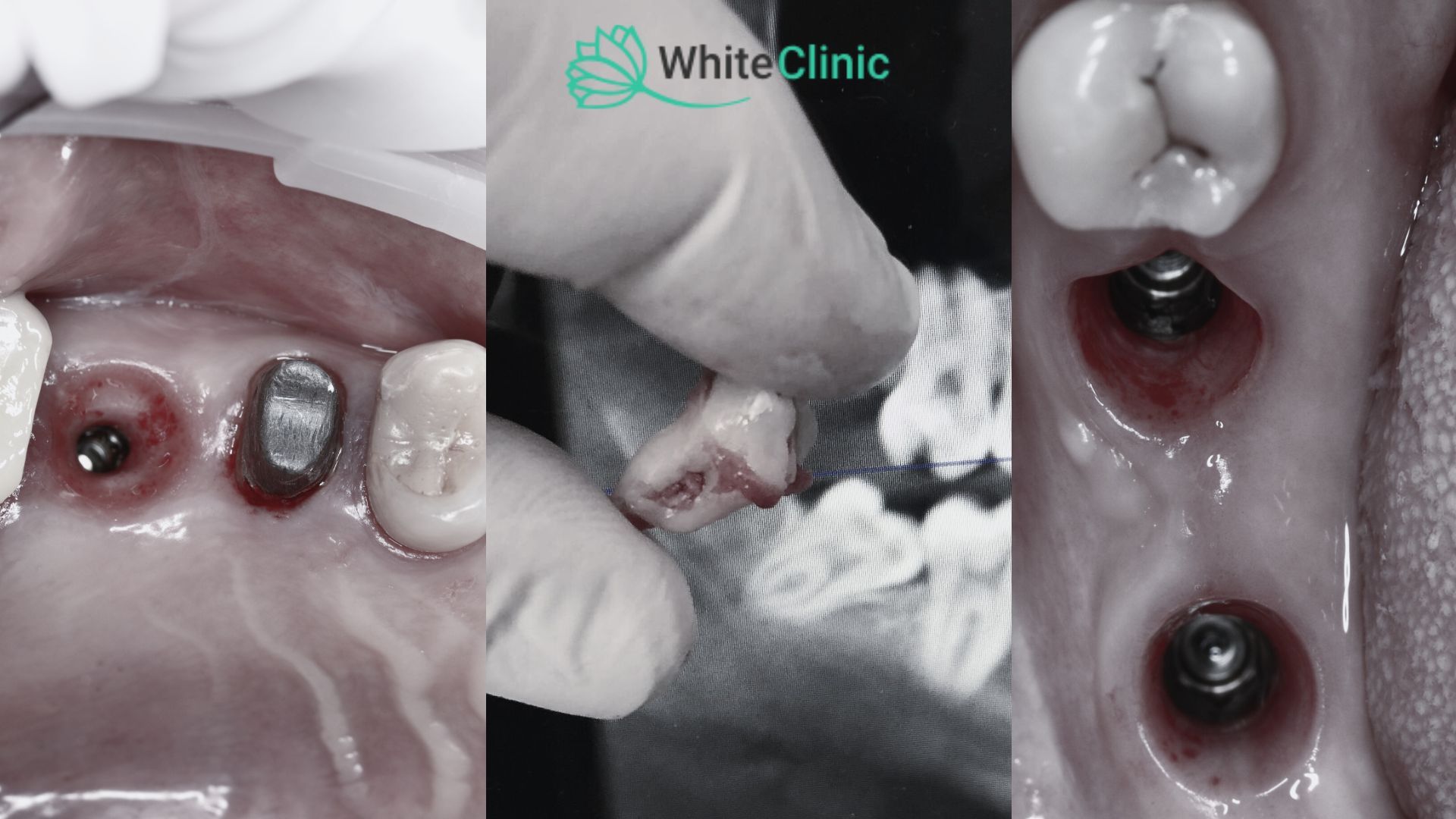 Протезування, видалення зубу мудрості, імплантація