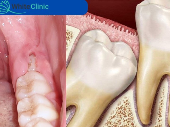Що робити, коли ріже зуб мудрості?
