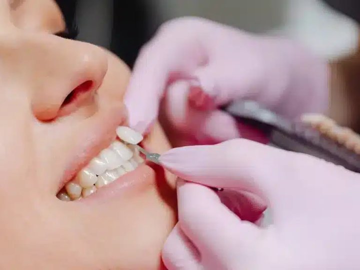 Різниця між композитними та керамічними вінірами