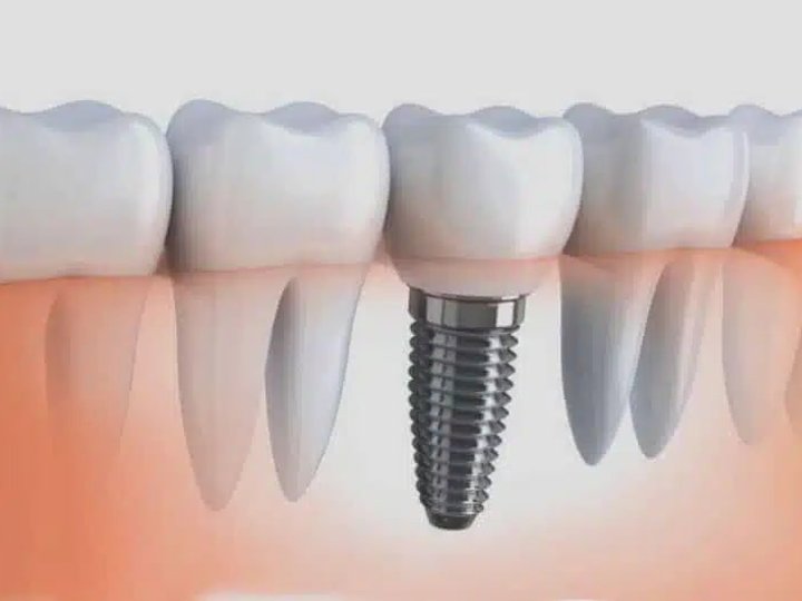 Технологічні інновації в імплантації зубів