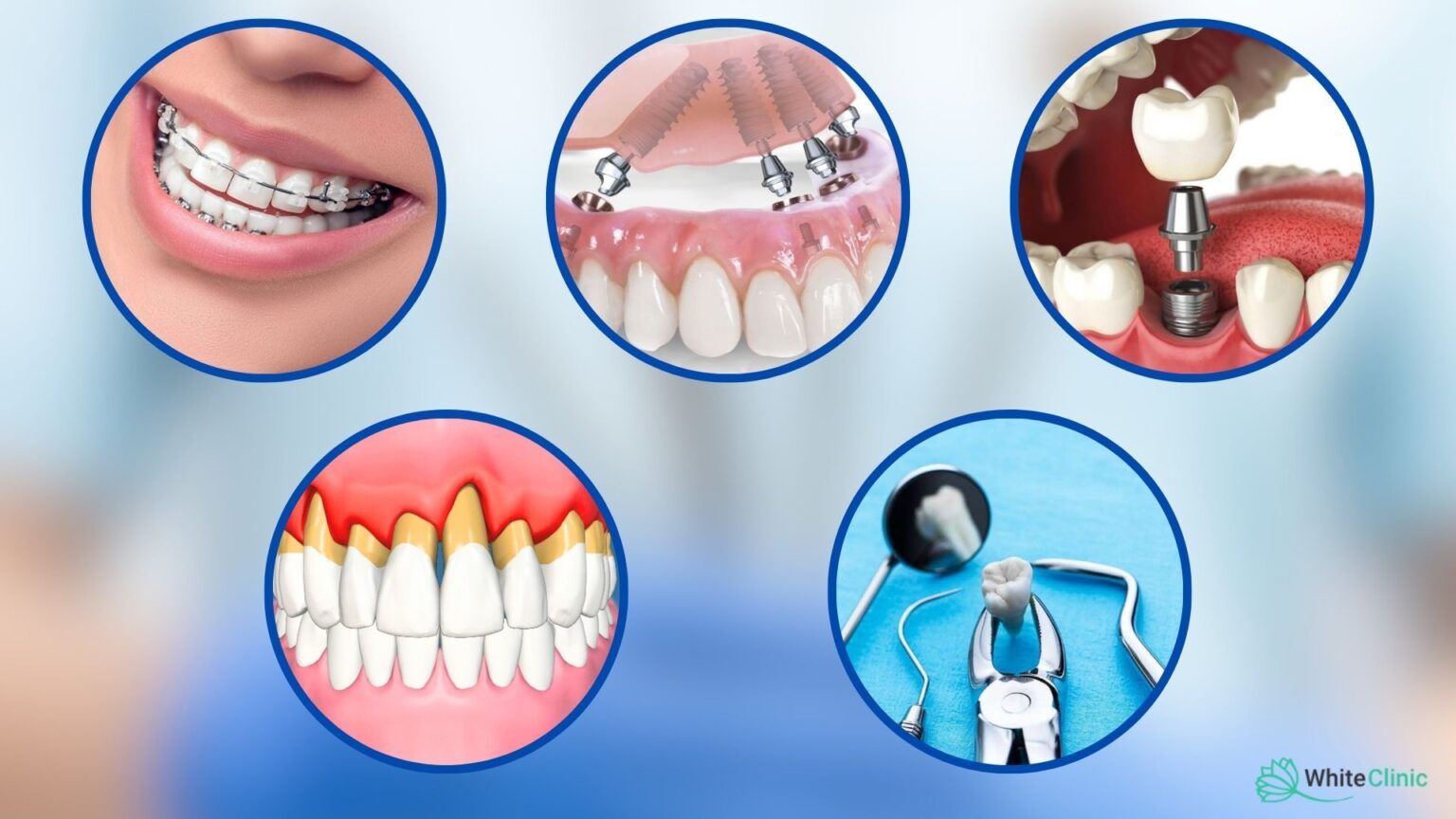 Vydalennja Zuba Mudrosti Pry Inshyh Stomatologichnyh Protsedurah 1536x864