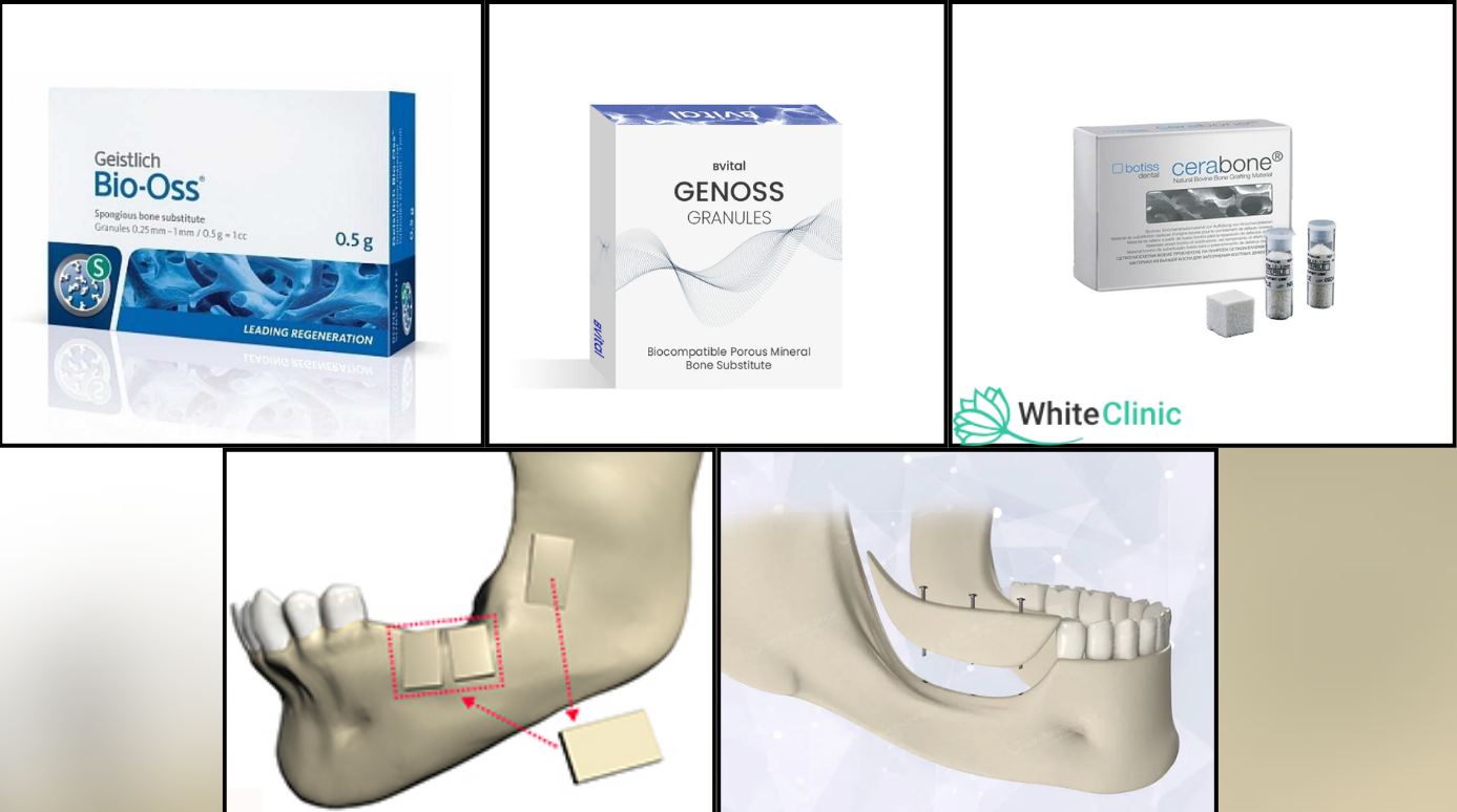 Bio-Oss (Швейцарія), Gen-Oss (Італія) та Cerabone (Німеччина)