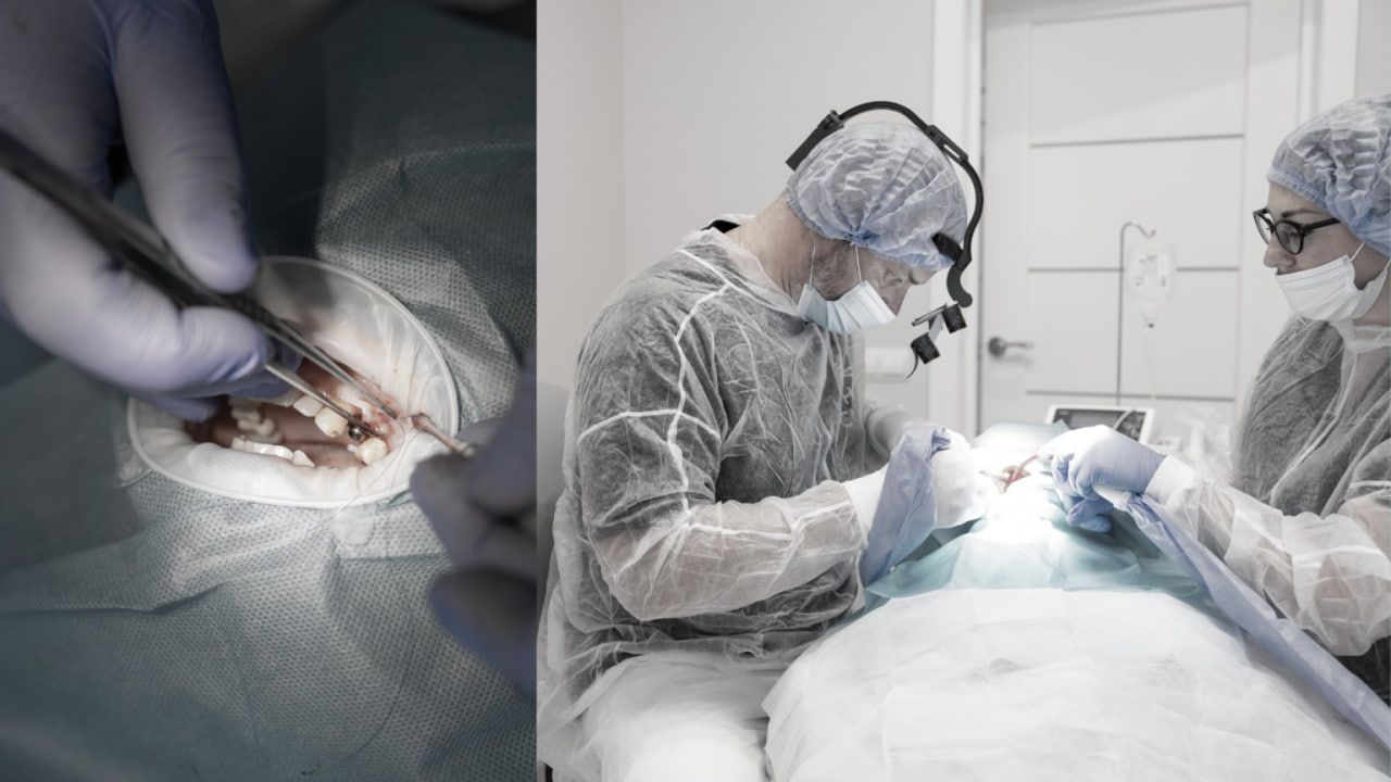 Процедура кісткової пластики для подальшої імплантації