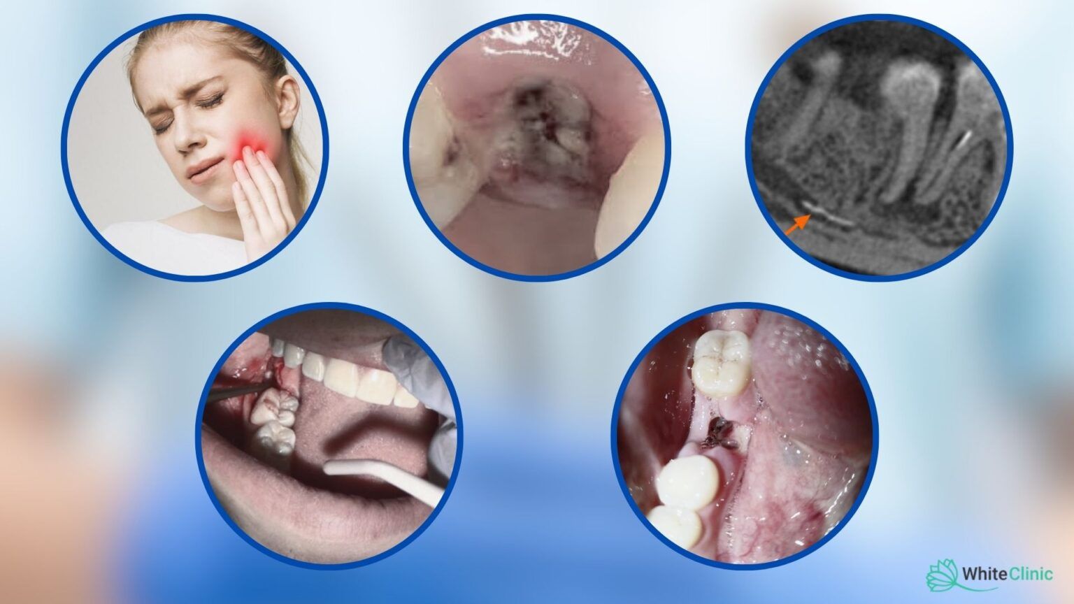 Uskladnennja Pry Vydalenni Zuba Mudrosti 1536x864