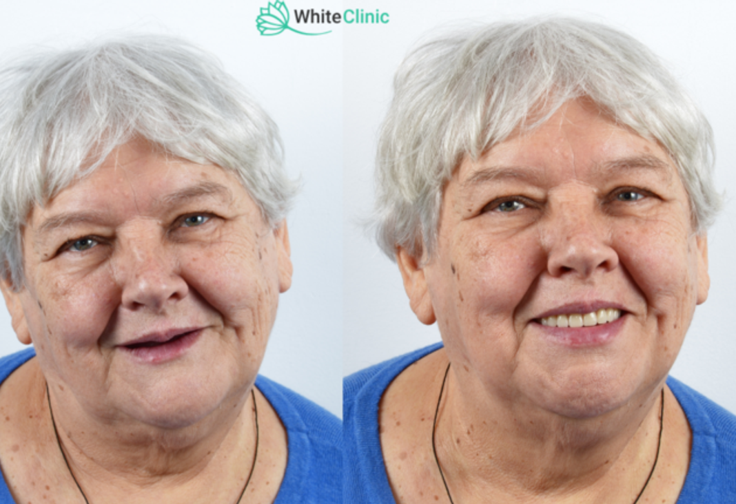 Implantasiaprotezi 768x432