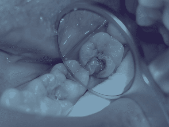 Лікування пульпіту: симптоми, діагностика та сучасні методи терапії