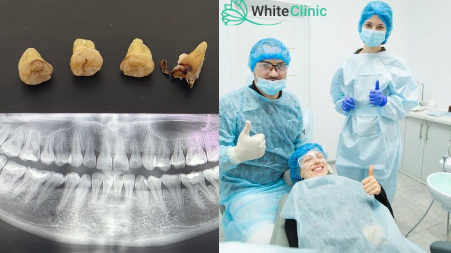 Vydalennja Zuba Mudrosti U White Clinic Na Poznjakah 1536x864