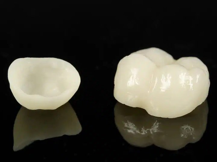 Все про керамічні коронки: переваги та особливості