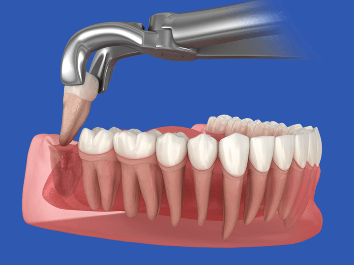 Легке і безболісне видалення зуба мудрості