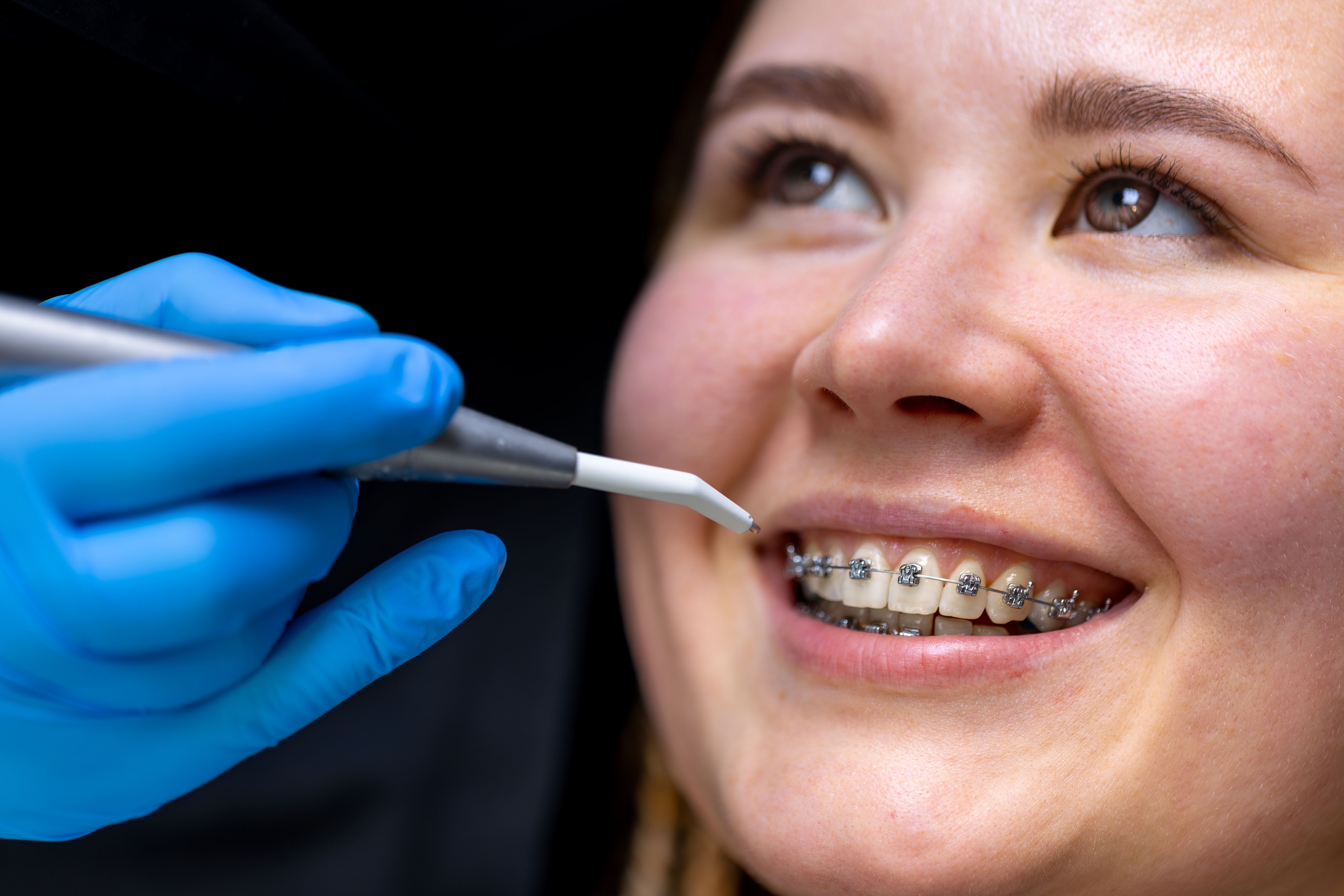 Dental Procedure Installing Braces Close up Dentistry Braces Teeth (3)