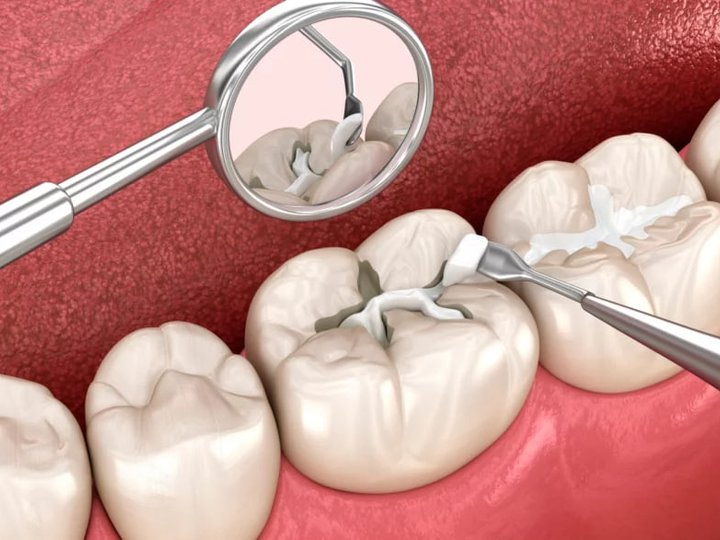 Герметизація фісур: для чого потрібна ця процедура і як вона проводиться