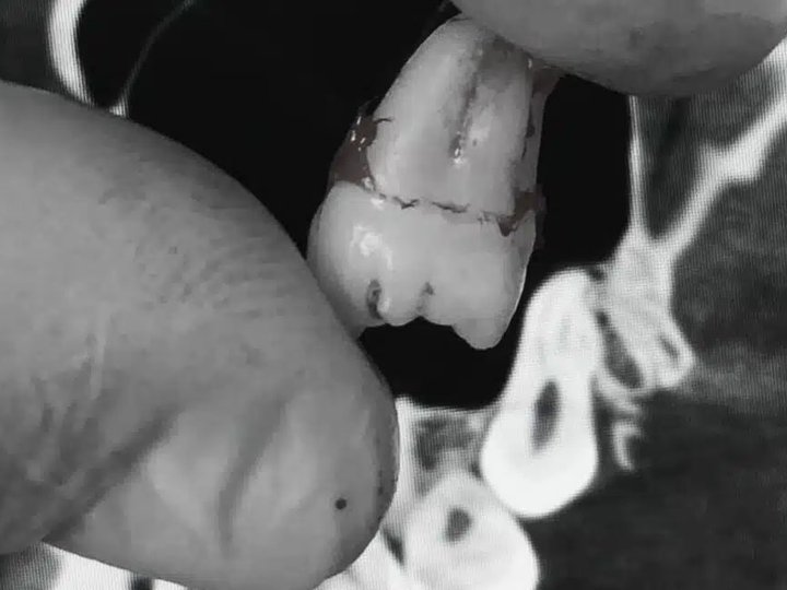 Як проходить атипове видалення зуба