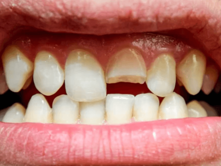 Що робити, якщо відколовся зуб?