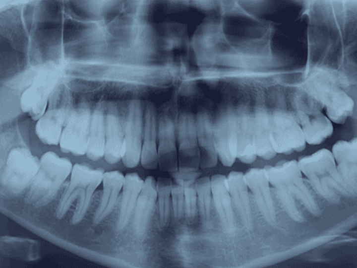 Ретеновані зуби: причини, діагностика та ефективне лікування
