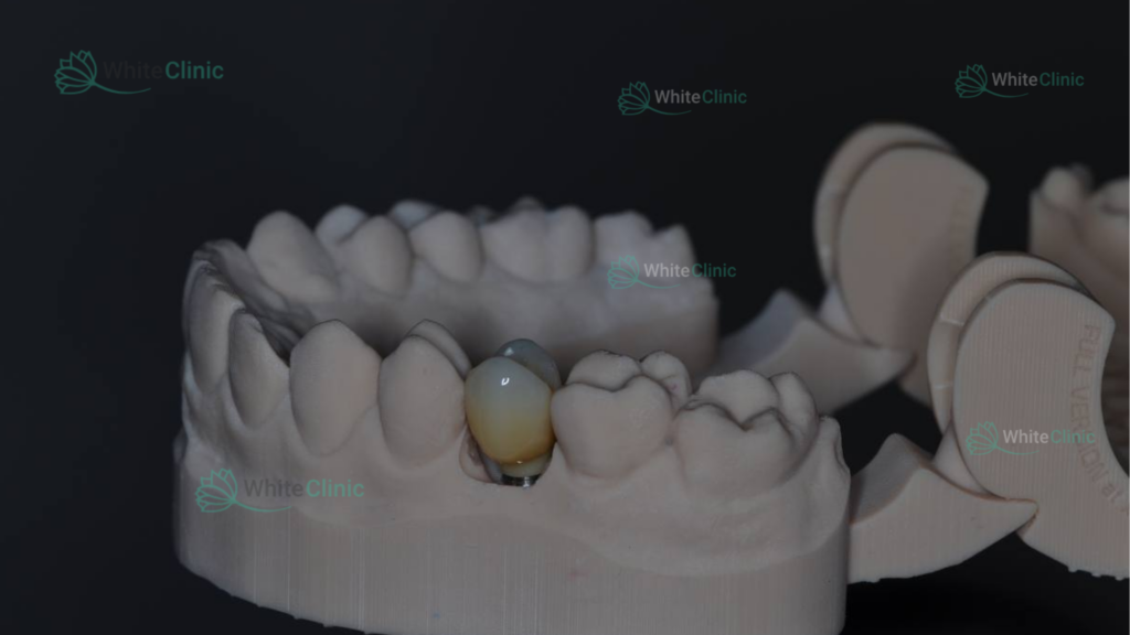 Forma Implantu 1024x576